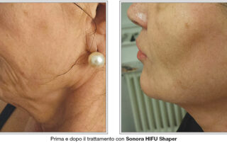 Sonora-HIFU-Sharper_foto_prima-dopo