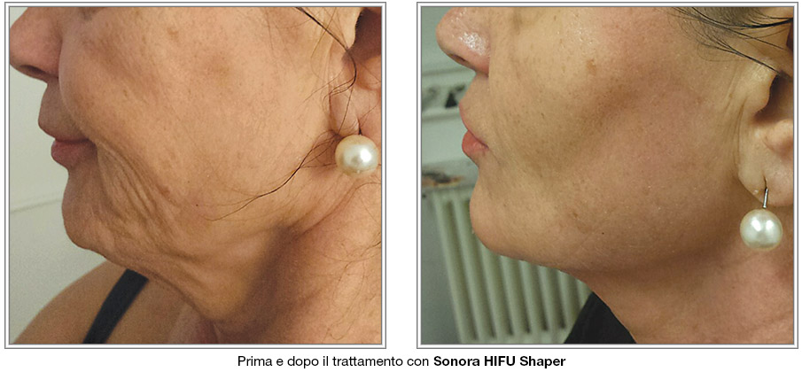 Sonora-HIFU-Sharper foto Prima e dopo trattamento con Sonora HIFU